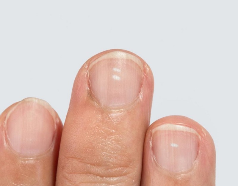 common nail diseases